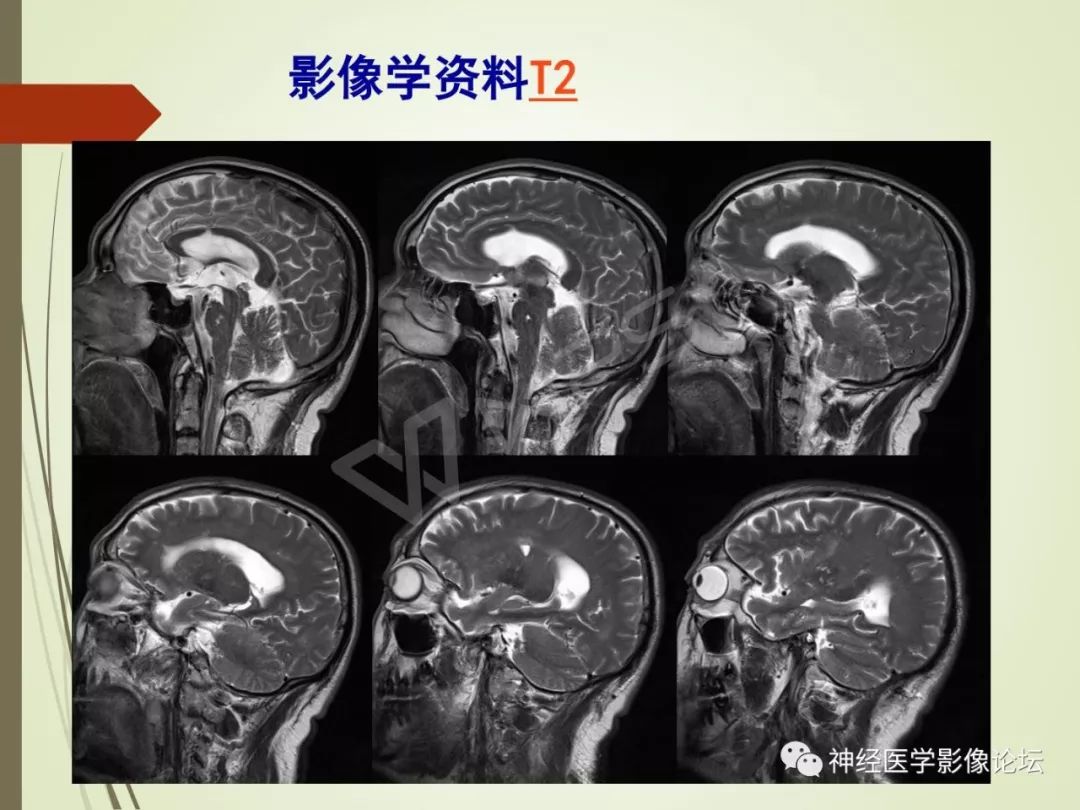 【病例】丘脑对称性病变之硬脑膜动静脉瘘并丘脑-基底节区静脉性脑梗塞1例CT及MR