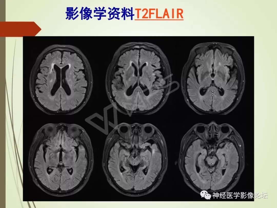 【病例】丘脑对称性病变之硬脑膜动静脉瘘并丘脑-基底节区静脉性脑梗塞1例CT及MR