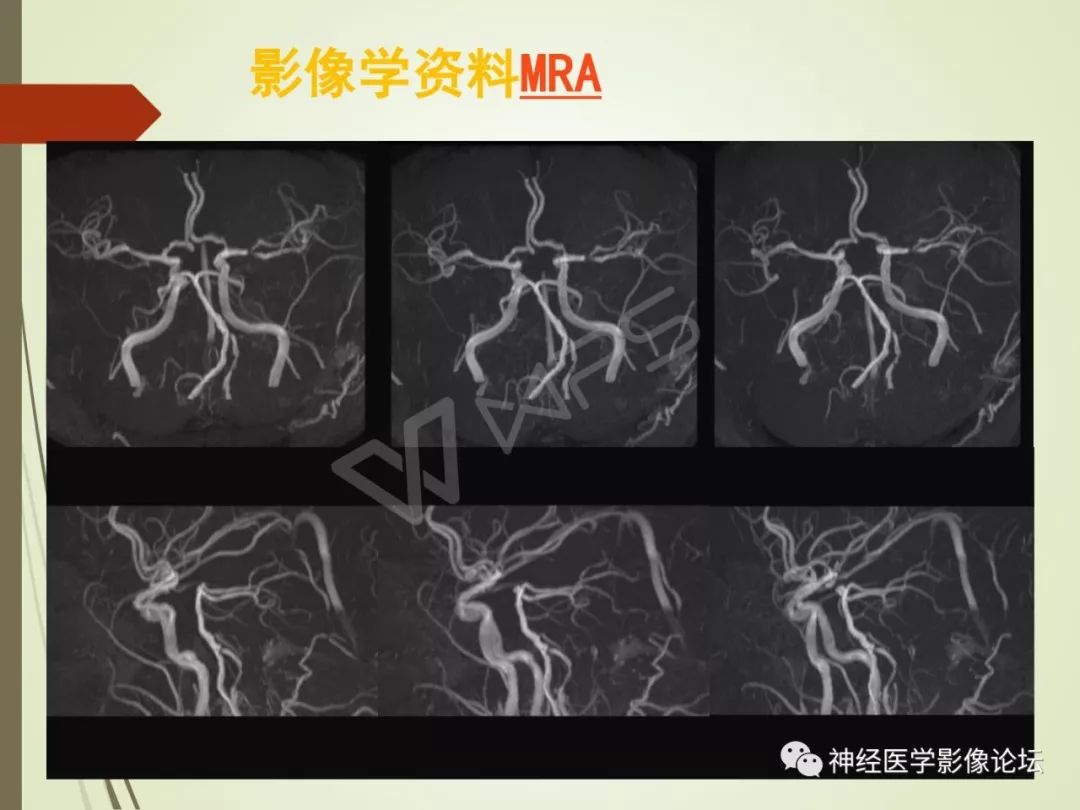 【病例】丘脑对称性病变之硬脑膜动静脉瘘并丘脑-基底节区静脉性脑梗塞1例CT及MR