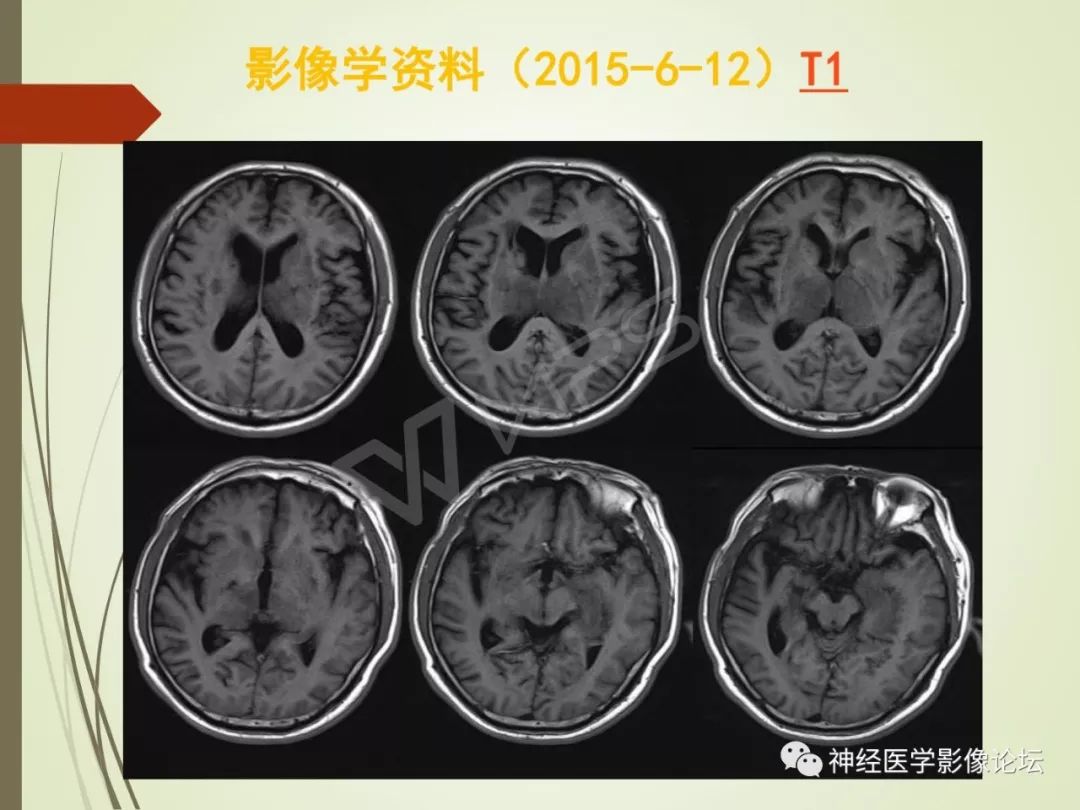 【病例】丘脑对称性病变之硬脑膜动静脉瘘并丘脑-基底节区静脉性脑梗塞1例CT及MR