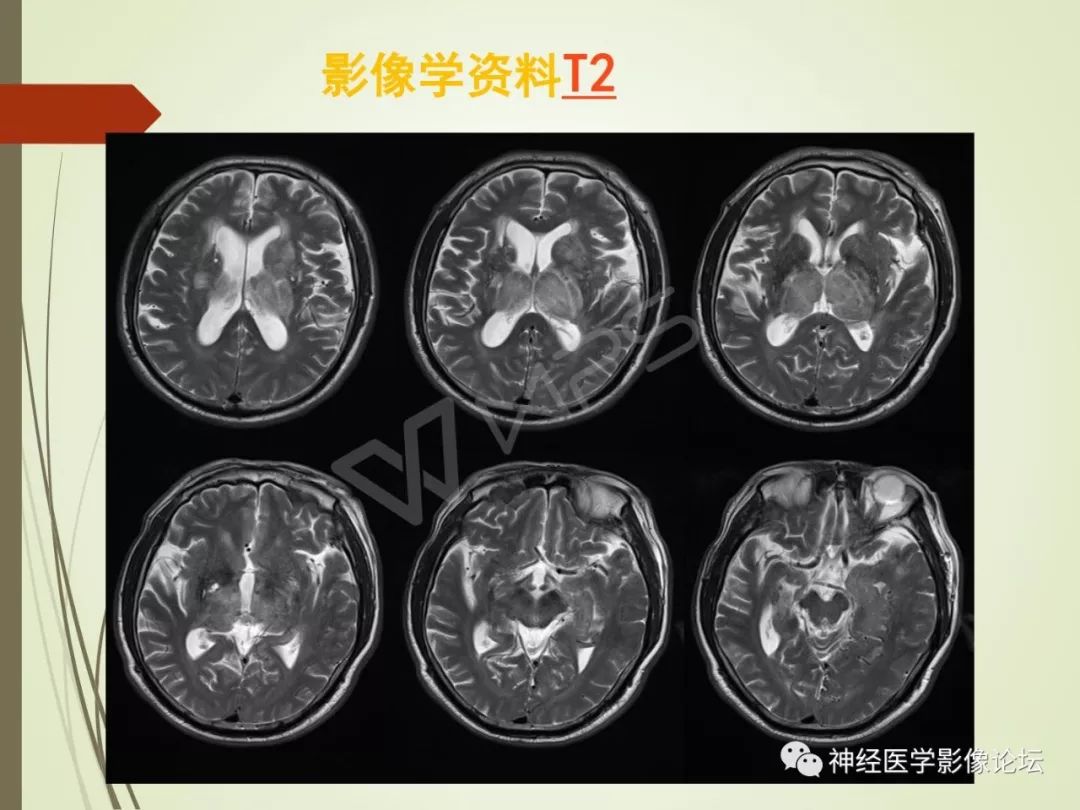 【病例】丘脑对称性病变之硬脑膜动静脉瘘并丘脑-基底节区静脉性脑梗塞1例CT及MR