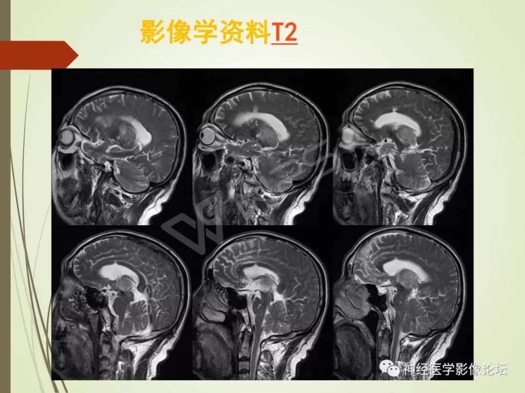 【病例】丘脑对称性病变之硬脑膜动静脉瘘并丘脑-基底节区静脉性脑梗塞1例CT及MR