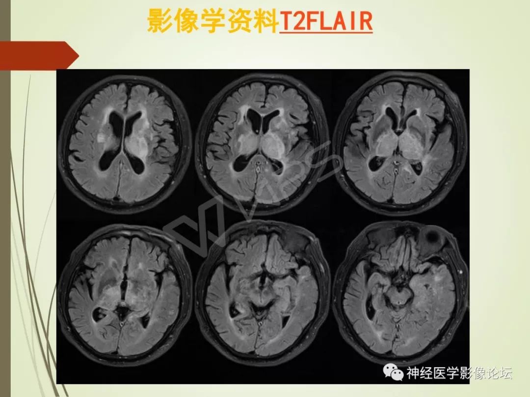 【病例】丘脑对称性病变之硬脑膜动静脉瘘并丘脑-基底节区静脉性脑梗塞1例CT及MR