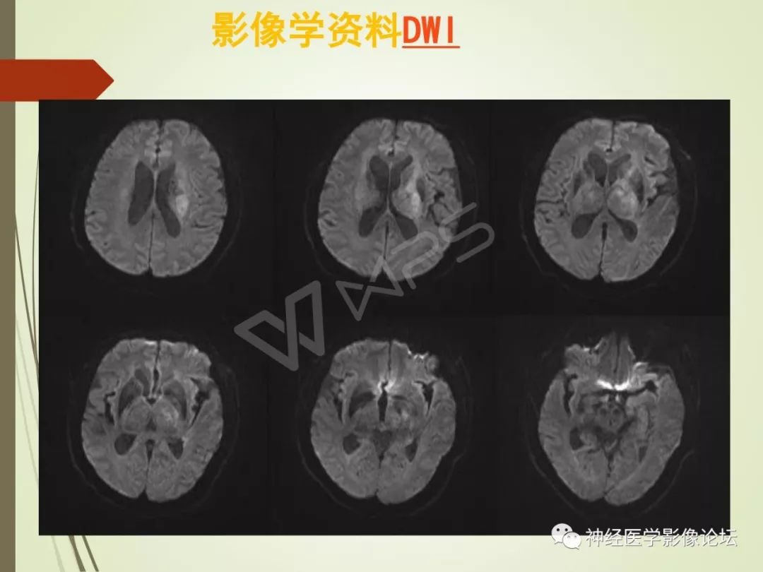 【病例】丘脑对称性病变之硬脑膜动静脉瘘并丘脑-基底节区静脉性脑梗塞1例CT及MR