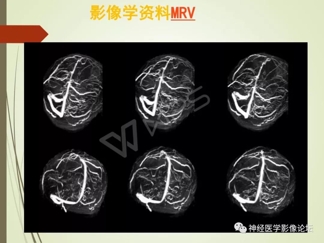 【病例】丘脑对称性病变之硬脑膜动静脉瘘并丘脑-基底节区静脉性脑梗塞1例CT及MR