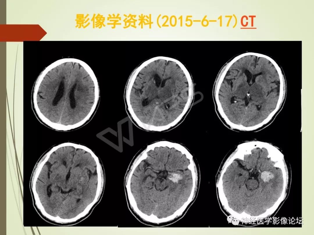 【病例】丘脑对称性病变之硬脑膜动静脉瘘并丘脑-基底节区静脉性脑梗塞1例CT及MR