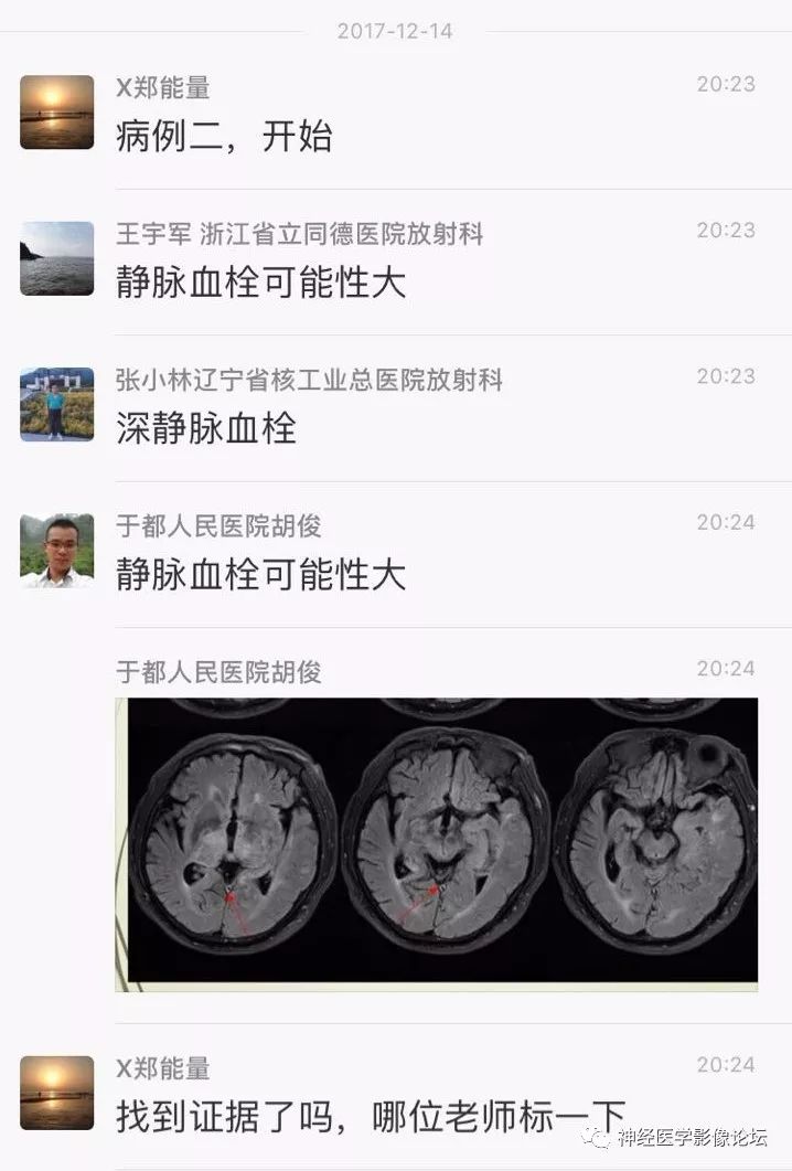 【病例】丘脑对称性病变之硬脑膜动静脉瘘并丘脑-基底节区静脉性脑梗塞1例CT及MR