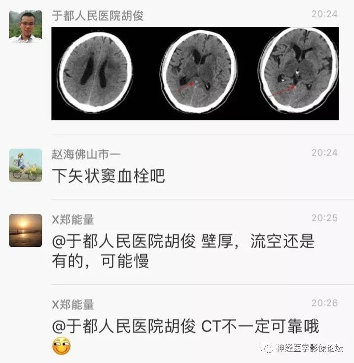 【病例】丘脑对称性病变之硬脑膜动静脉瘘并丘脑-基底节区静脉性脑梗塞1例CT及MR