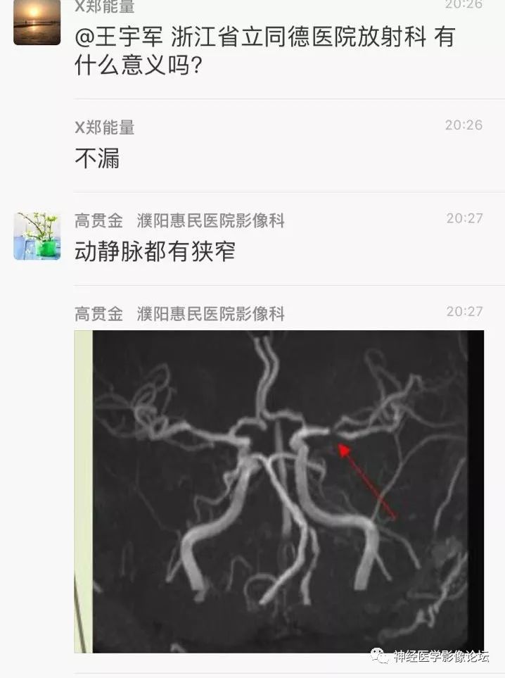 【病例】丘脑对称性病变之硬脑膜动静脉瘘并丘脑-基底节区静脉性脑梗塞1例CT及MR