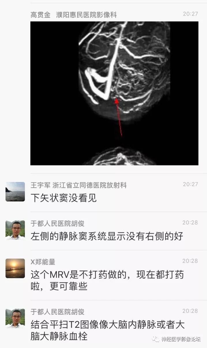 【病例】丘脑对称性病变之硬脑膜动静脉瘘并丘脑-基底节区静脉性脑梗塞1例CT及MR