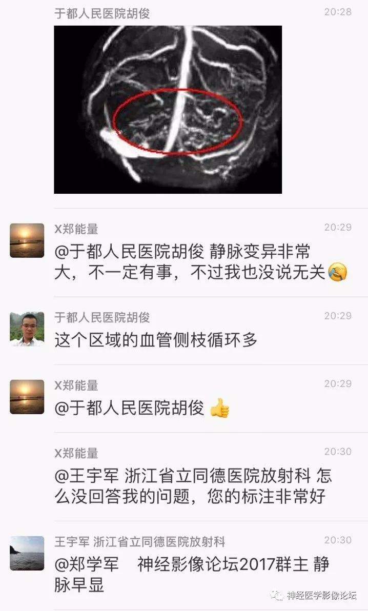 【病例】丘脑对称性病变之硬脑膜动静脉瘘并丘脑-基底节区静脉性脑梗塞1例CT及MR