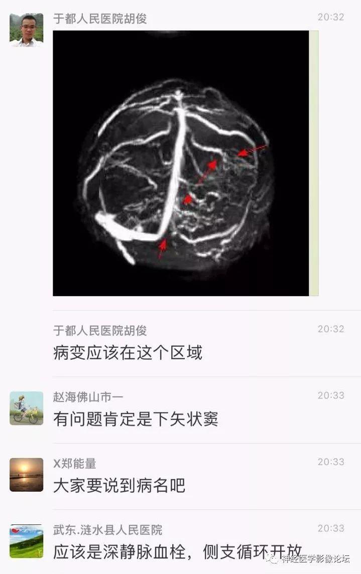 【病例】丘脑对称性病变之硬脑膜动静脉瘘并丘脑-基底节区静脉性脑梗塞1例CT及MR