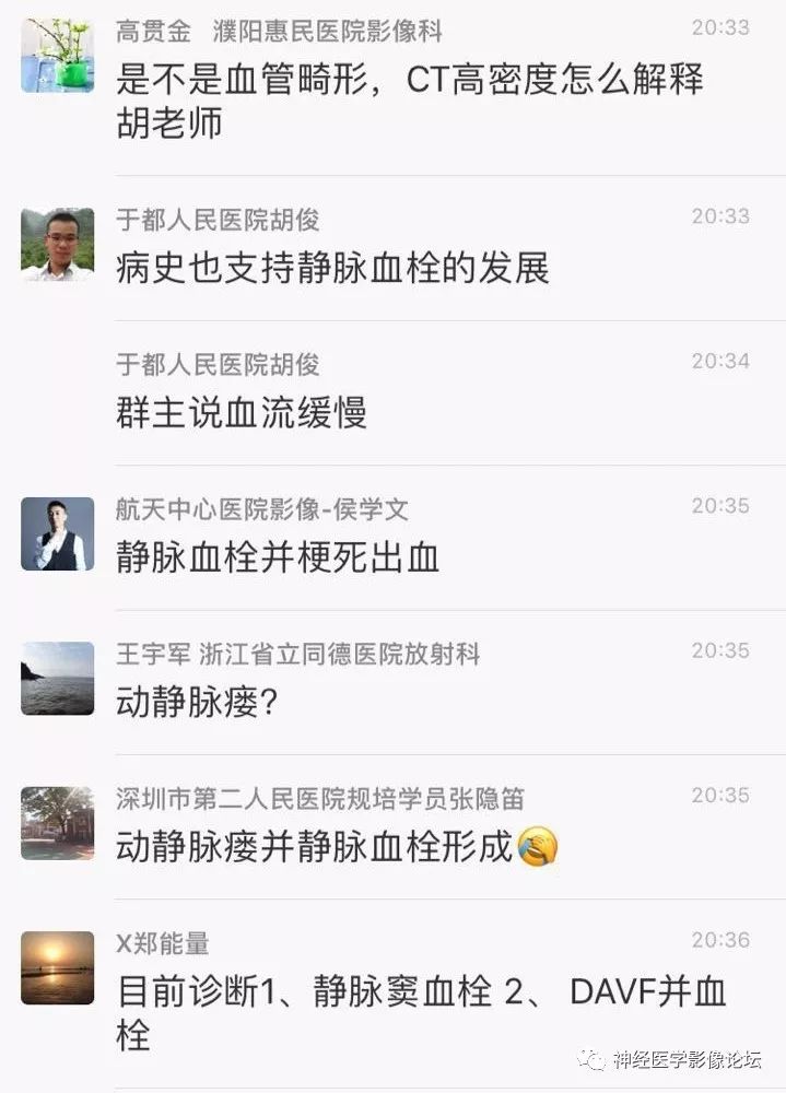 【病例】丘脑对称性病变之硬脑膜动静脉瘘并丘脑-基底节区静脉性脑梗塞1例CT及MR