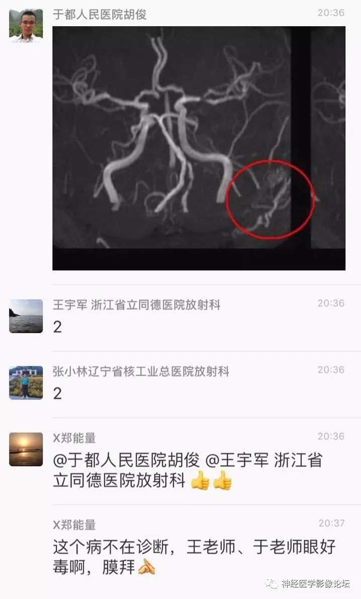 【病例】丘脑对称性病变之硬脑膜动静脉瘘并丘脑-基底节区静脉性脑梗塞1例CT及MR