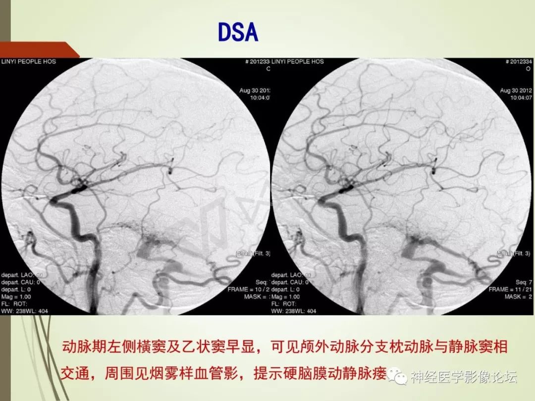 【病例】丘脑对称性病变之硬脑膜动静脉瘘并丘脑-基底节区静脉性脑梗塞1例CT及MR