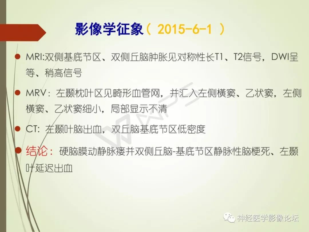 【病例】丘脑对称性病变之硬脑膜动静脉瘘并丘脑-基底节区静脉性脑梗塞1例CT及MR