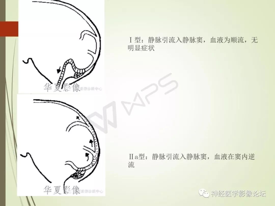 【病例】丘脑对称性病变之硬脑膜动静脉瘘并丘脑-基底节区静脉性脑梗塞1例CT及MR