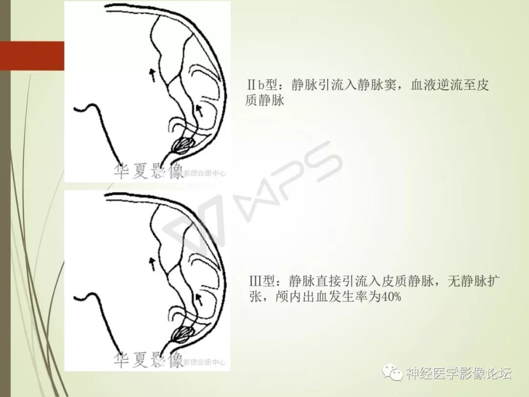 【病例】丘脑对称性病变之硬脑膜动静脉瘘并丘脑-基底节区静脉性脑梗塞1例CT及MR