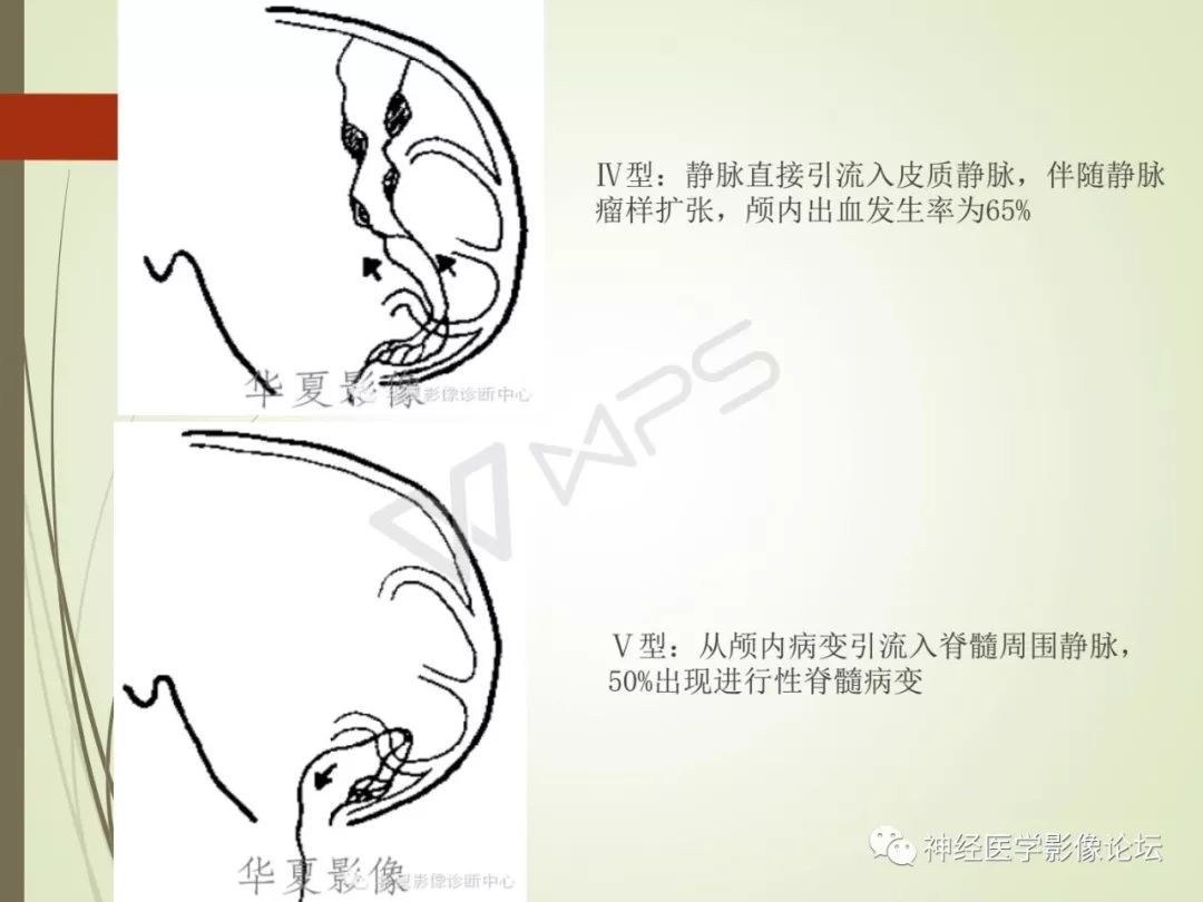 【病例】丘脑对称性病变之硬脑膜动静脉瘘并丘脑-基底节区静脉性脑梗塞1例CT及MR