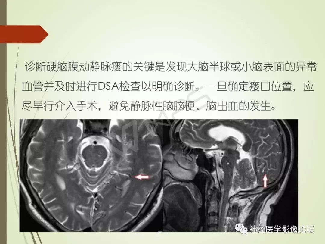 【病例】丘脑对称性病变之硬脑膜动静脉瘘并丘脑-基底节区静脉性脑梗塞1例CT及MR
