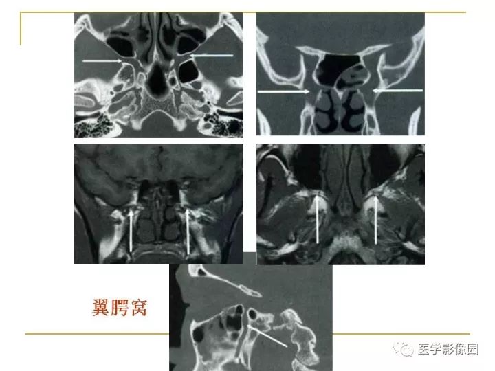 【PPT】翼腭窝影像解剖及常见病变