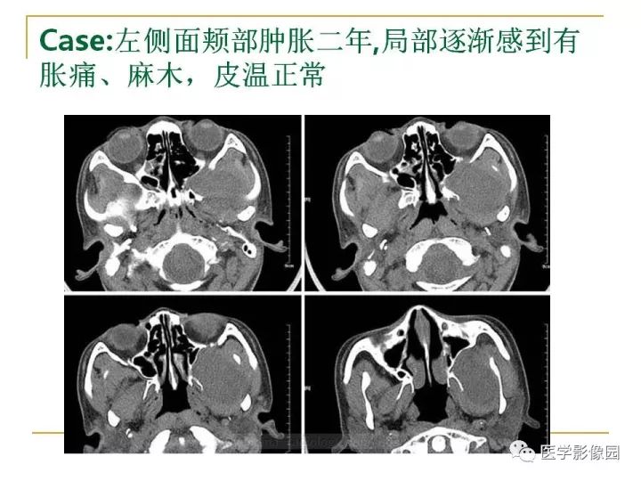 【PPT】翼腭窝影像解剖及常见病变