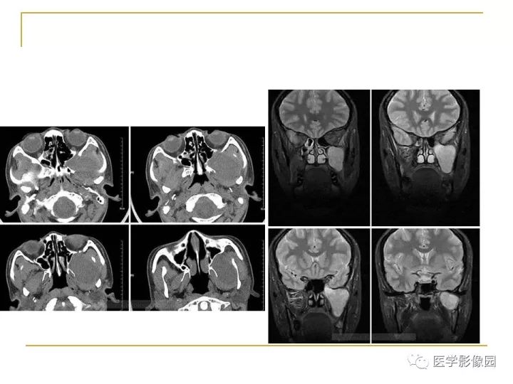 【PPT】翼腭窝影像解剖及常见病变