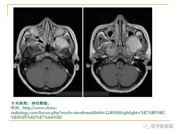 【PPT】翼腭窝影像解剖及常见病变