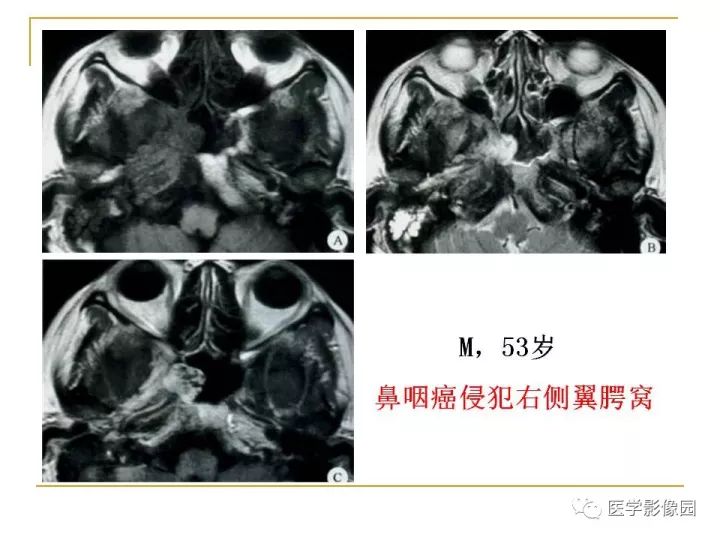 【PPT】翼腭窝影像解剖及常见病变