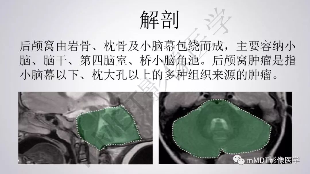 【PPT】后颅窝常见肿瘤的诊断