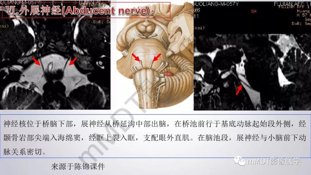 【PPT】后颅窝常见肿瘤的诊断