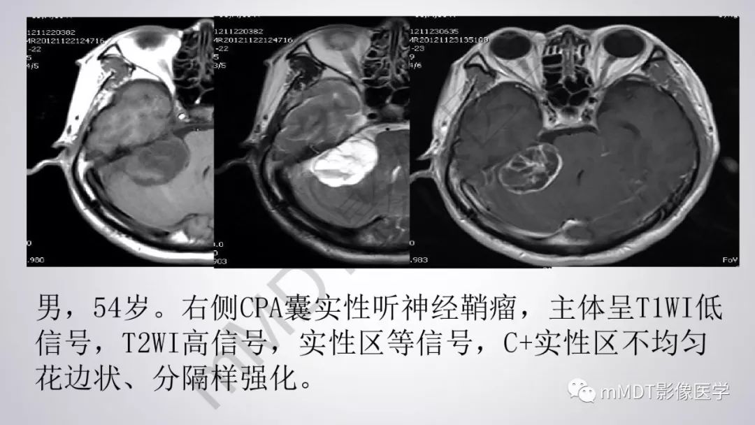 【PPT】后颅窝常见肿瘤的诊断