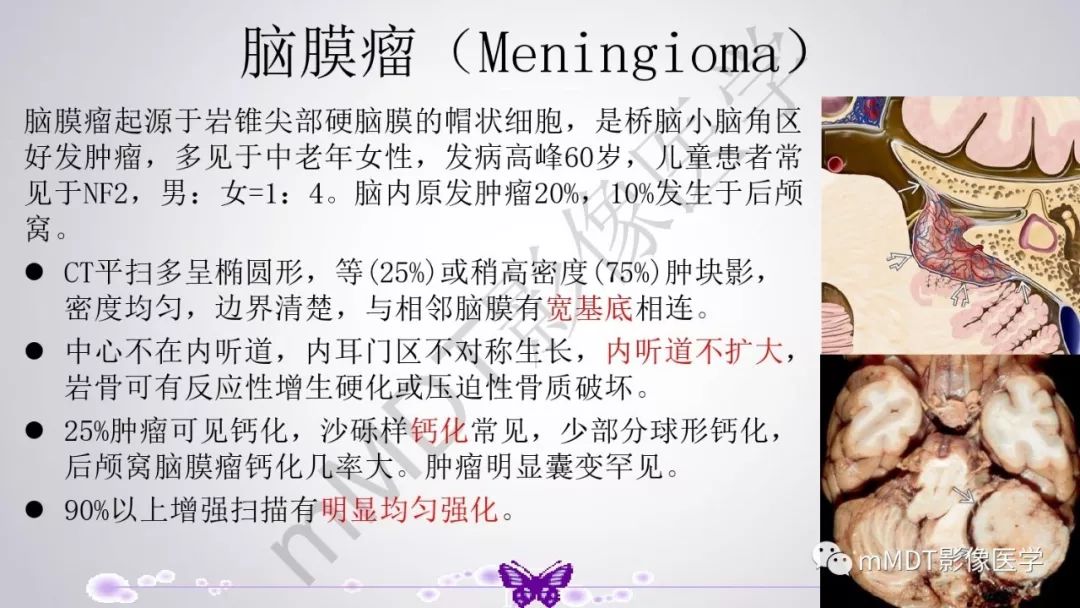 【PPT】后颅窝常见肿瘤的诊断