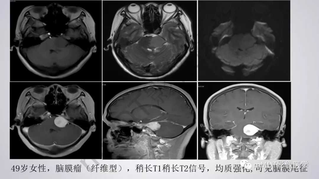 【PPT】后颅窝常见肿瘤的诊断