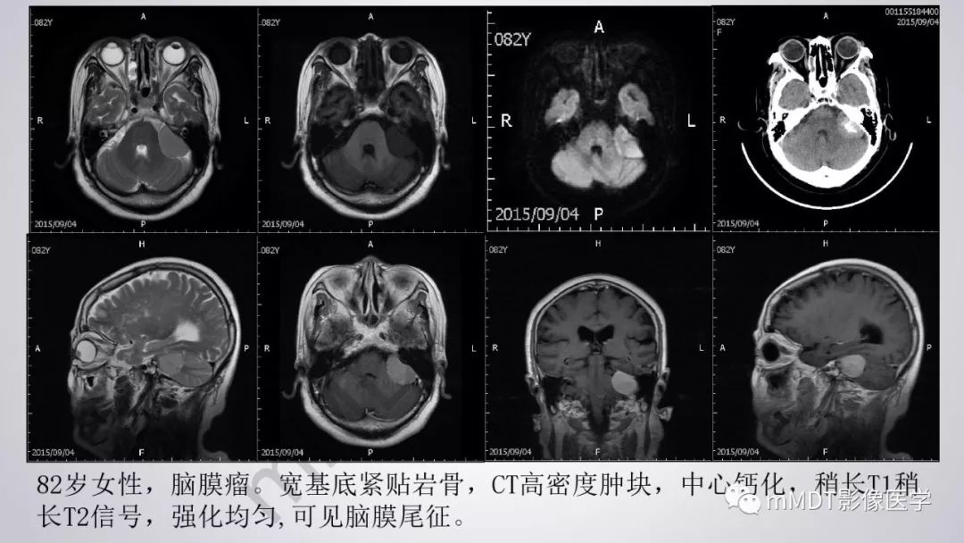 【PPT】后颅窝常见肿瘤的诊断
