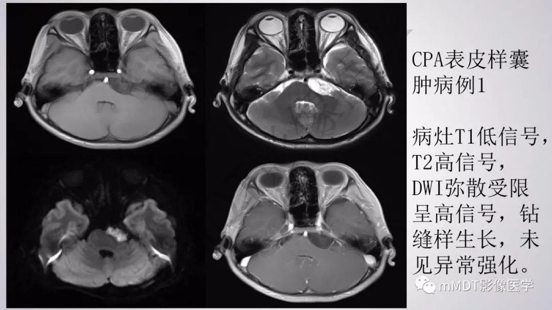 【PPT】后颅窝常见肿瘤的诊断