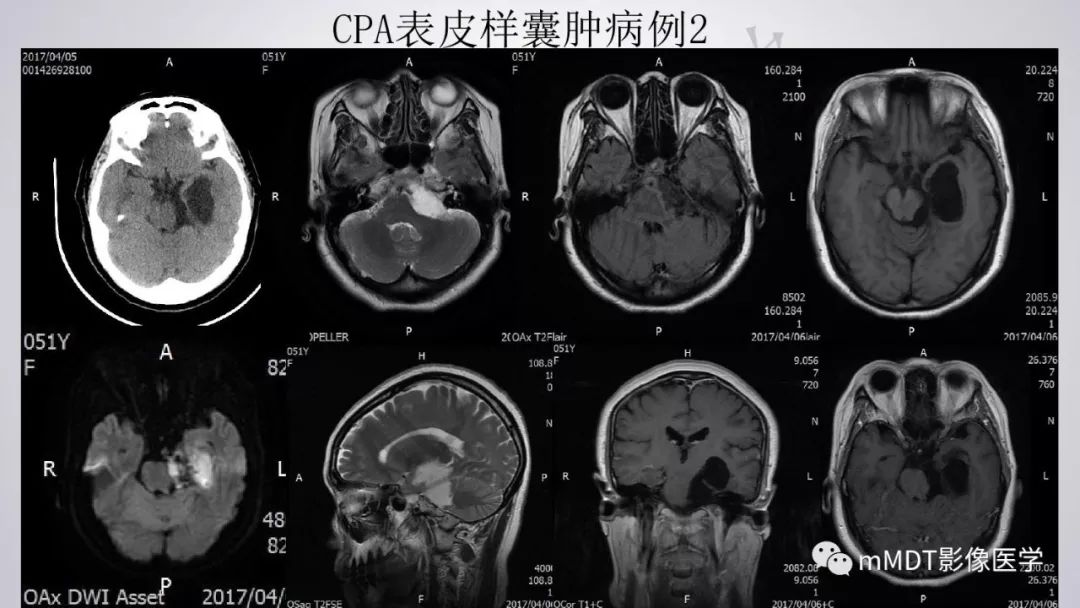 【PPT】后颅窝常见肿瘤的诊断