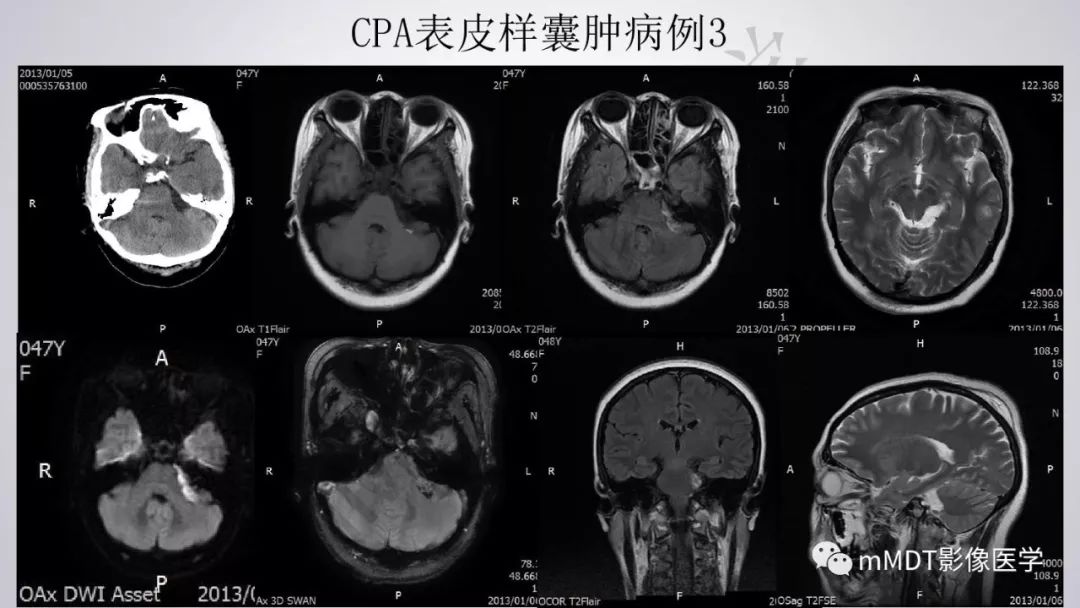 【PPT】后颅窝常见肿瘤的诊断