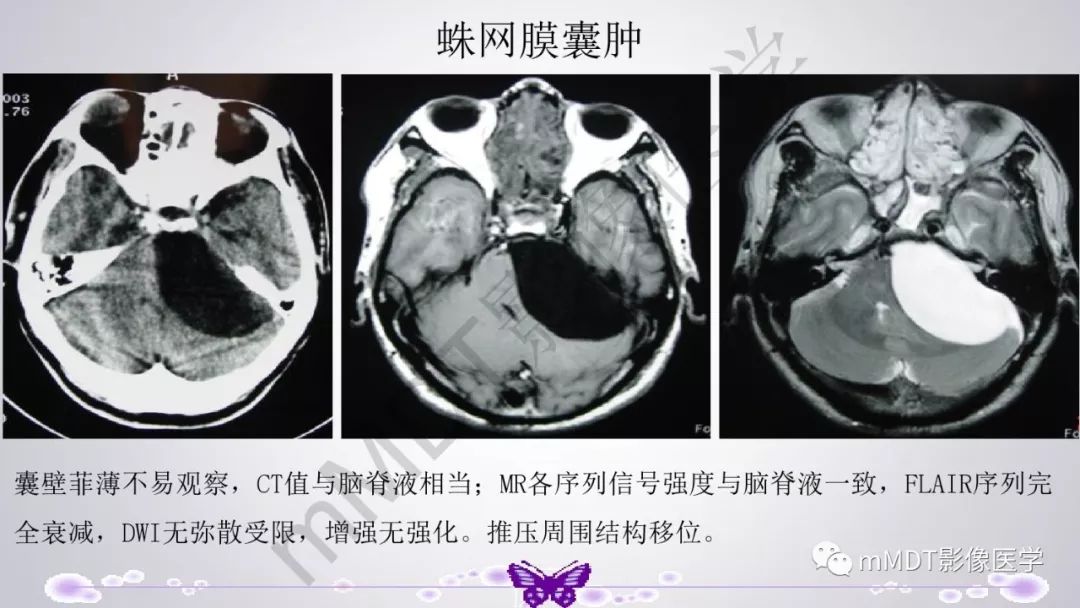 【PPT】后颅窝常见肿瘤的诊断