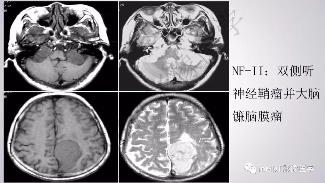【PPT】后颅窝常见肿瘤的诊断