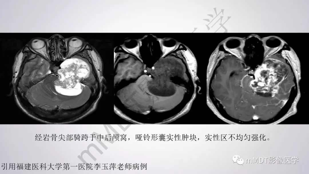 【PPT】后颅窝常见肿瘤的诊断