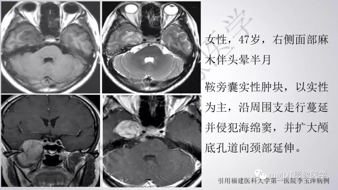 【PPT】后颅窝常见肿瘤的诊断