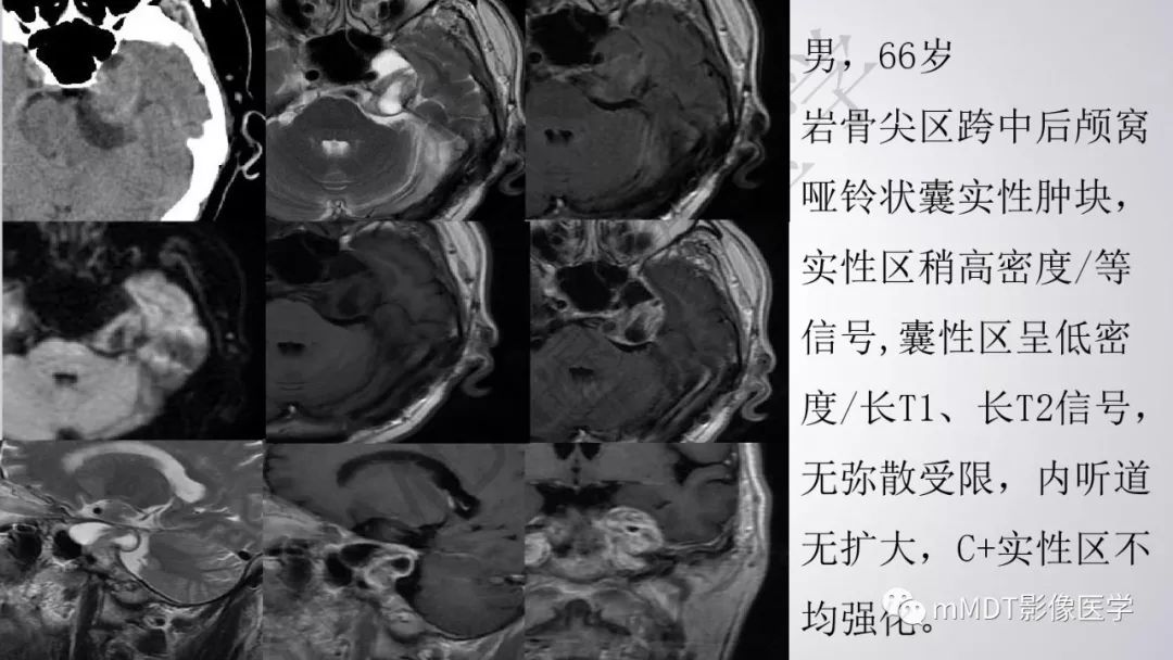【PPT】后颅窝常见肿瘤的诊断