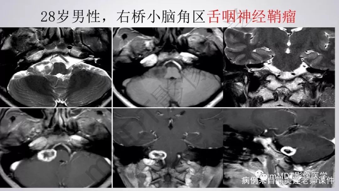【PPT】后颅窝常见肿瘤的诊断