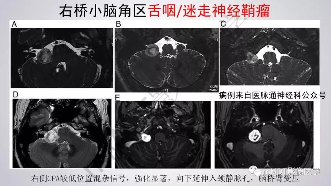 【PPT】后颅窝常见肿瘤的诊断