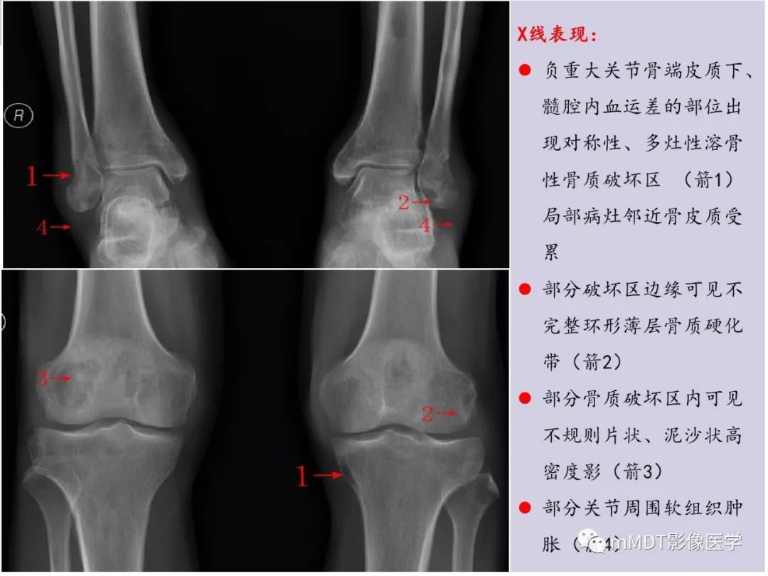 【PPT】多灶性骨病影像分析思路(不常见感染篇)