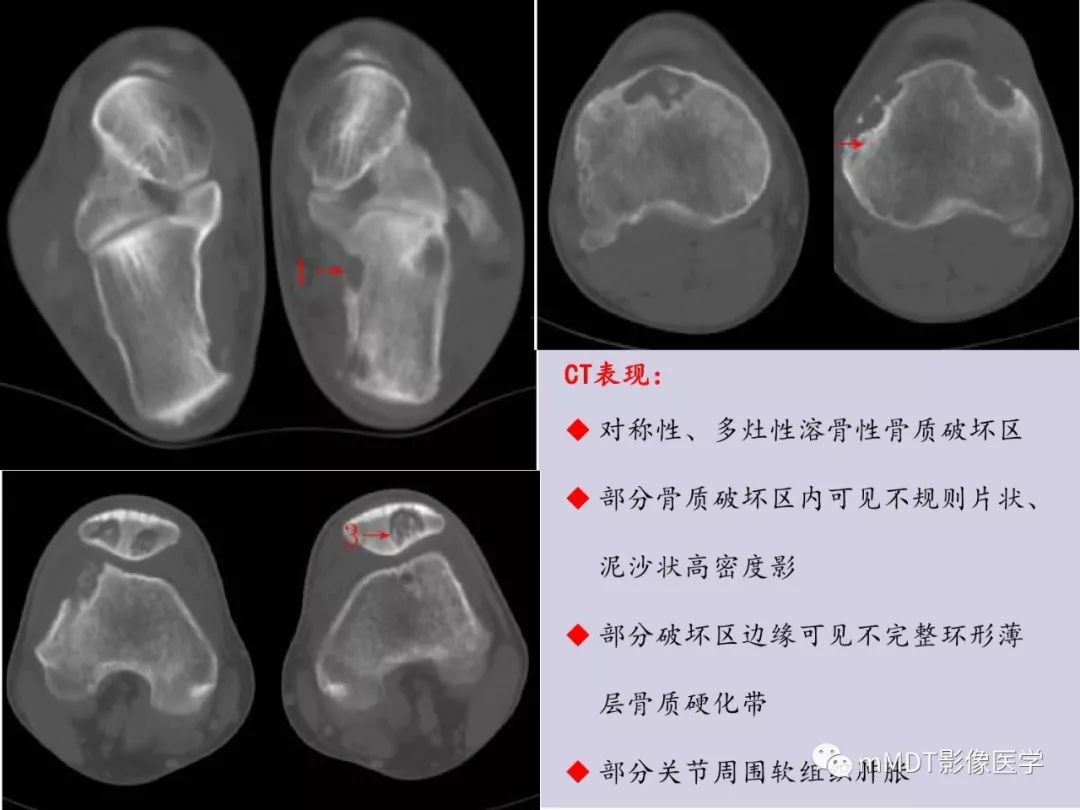 【PPT】多灶性骨病影像分析思路(不常见感染篇)