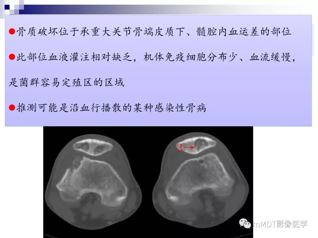 【PPT】多灶性骨病影像分析思路(不常见感染篇)