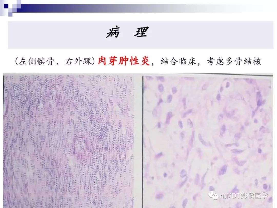 【PPT】多灶性骨病影像分析思路(不常见感染篇)