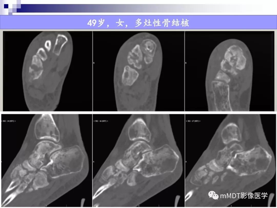 【PPT】多灶性骨病影像分析思路(不常见感染篇)
